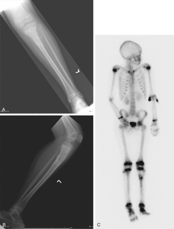 Figure 89.3, (A) Anteroposterior radiograph of a 9-year-old girl with an osteosarcoma of the left proximal tibia. The tumor is both destructive of bone and osteoblastic, increasing the density of the proximal metaphysis of the bone. The mineralized soft tissue mass is visible. (B) Lateral radiograph shows the mixed radiolucent and radiodense characteristics of the tumor, and the mineralization of the soft tissue mass appears posterior to the bone. This flocculent mineralization of density similar to that of normal bone is characteristic. In this case, perpendicular striations of bone are visible posteriorly. (C) Radionuclide bone scan shows increased uptake in the proximal metaphysis of the tibia. No skip lesions or other bony metastases were noted. (D) Coronal short tau inversion recovery (STIR) magnetic resonance image shows the extent of the tumor (bright on this sequence) in the medullary cavity and soft tissues. The tumor has transgressed the growth plate and may involve the knee joint. (E) Axial T1-weighted fat-saturation magnetic resonance image shows the soft tissue mass and relationship to the posterior vessels. (F) Sagittal T1-weighted fat-saturation image shows the medullary extent of the tumor and the extension into the epiphysis further suggests involvement of the knee joint. In this particular case, the tumor did extend under the lateral meniscus but was covered by synovium and not technically in the joint proper. An extraarticular, above-knee amputation was done because of the potential joint involvement and her young age.