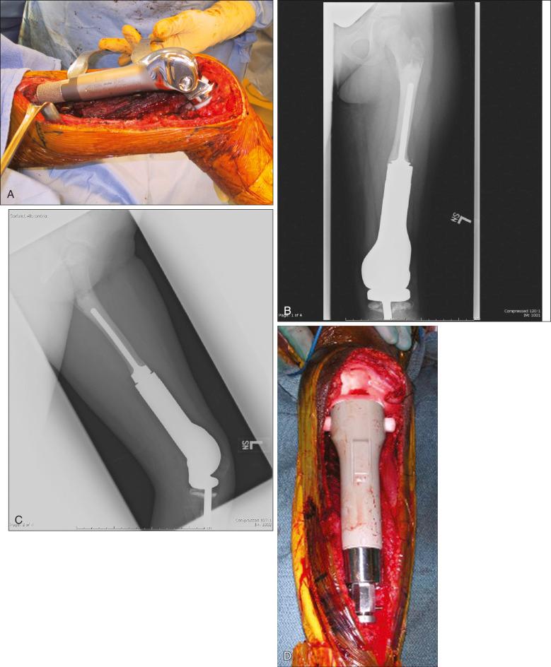 E-Figure 89.2, (A) Intraoperative photograph of an expandable prosthesis of the distal femur. This prosthesis contains an inner tube that will expand with periodic turning of a mechanical mechanism on the prosthesis. It requires a small operation to turn the mechanism with a screwdriver near the knee. At times, the pseudocapsule around the prosthesis needs to be excised to allow for expansion. (B–C) Anteroposterior and lateral radiographs of the prosthesis shown in (A). At adulthood, the prosthesis will require conversion to an adult prosthesis. (D) Intraoperative photograph of another type of expandable prosthesis. This prosthesis does not require an operation to expand. An electromagnetic coil is applied around the extremity under minimal sedation. The coil melts a component in the prosthesis, allowing a spring to expand the prosthesis under fluoroscopic control. When the coil is removed, the expansion stops. (E–F) Radiographs of the prosthesis shown in (A–D).