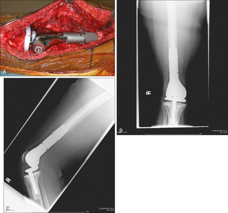 Figure 89.5, (A) Intraoperative photograph of a modular endoprosthesis for the distal femur. This prosthesis is cemented in place and has a rotating hinge knee design. The prosthetic stem is roughened near the femur implantation site to allow for tissue ingrowth. Length can be determined by selecting the proper body segment length and assembling it with Morse tapers. (B and C) Anteroposterior and lateral postoperative radiographs of the prosthesis in (A).