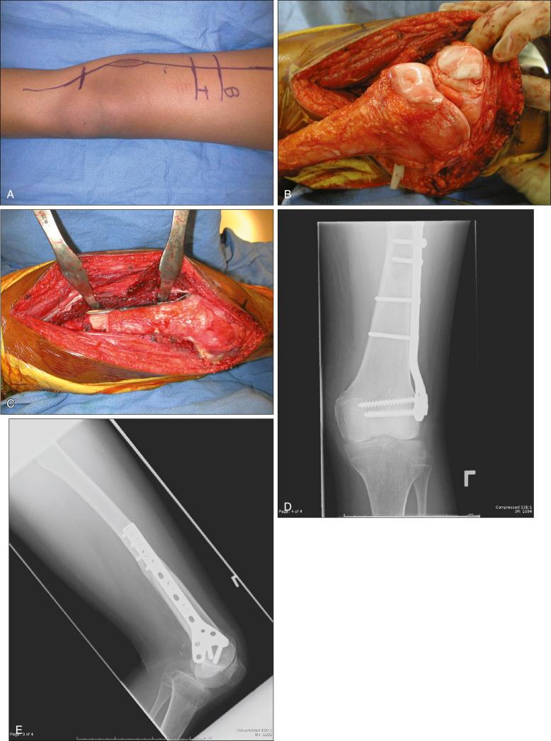 Figure 89.6, (A) Preoperative clinical photograph shows the incision for resection of the distal femur, including the biopsy tract. (B) Intraoperative photograph of an osteoarticular allograft of the distal femur before repairing the capsule. (C) Intraoperative photograph shows the osteosynthesis. (D–E) Postoperative radiographs 3 years postoperatively shows healing of the osteosynthesis site.