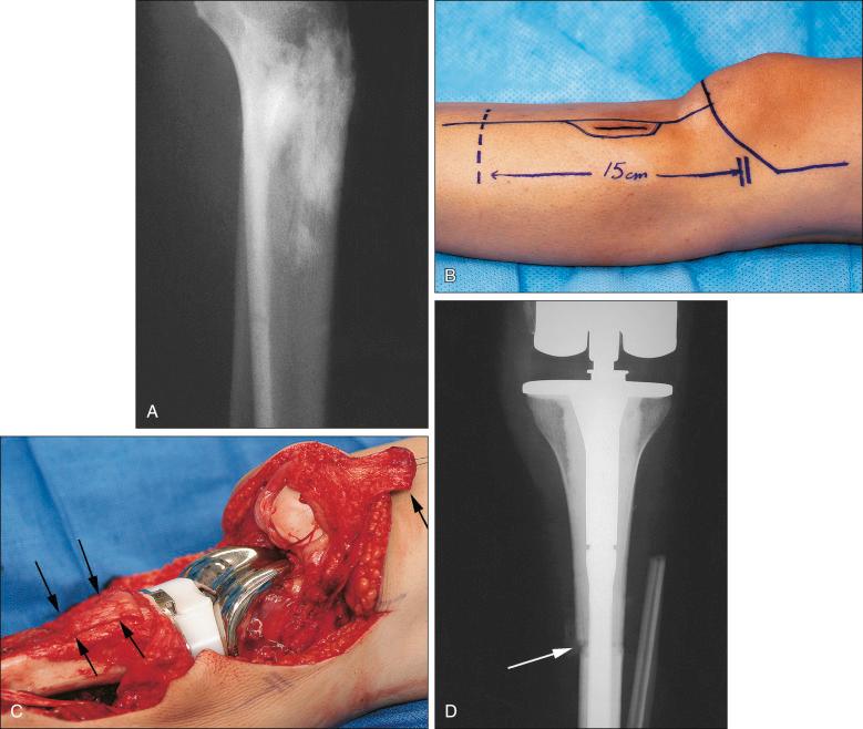 Figure 89.7, (A) A 27-year-old woman experienced a painful mass in the left proximal tibia approximately 3 weeks before medical evaluation. This lateral radiograph of the tibia demonstrates a dense, bone-producing lesion in the metaphysis associated with a soft tissue mass in the anterior compartment. (B) An open biopsy confirmed osteoblastic osteosarcoma, and all staging studies suggested that the patient was otherwise free of disease. After 12 weeks of standard preoperative multiagent chemotherapy, the patient was taken to the operating room for resection of 15 cm of the proximal tibia and adjuvant soft tissue to include the patellar tendon and the proximal fibula with sparing of the peroneal nerve. (C) Intraoperative photograph after tumor resection demonstrates reconstruction with use of a deep frozen allograft with the retained allograft patellar tendon (double arrows). The prosthesis was secured, and the host patellar tendon (single arrow) would be woven and sutured to the allograft tendon to restore the resected extensor mechanism. (D) Anteroposterior radiograph taken 3 months postoperatively demonstrates the composite allograft-prosthetic hybrid secured with methylmethacrylate and shows that the host-graft juncture (white arrow) with supplemental bone graft is healing with evidence of callus.