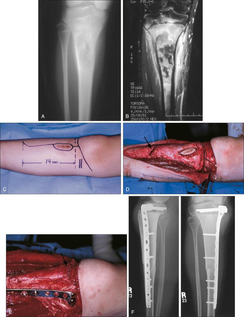 Figure 89.8, (A) This 16-year-old skeletally mature male athlete experienced pain and tenderness in the right proximal tibia while practicing for a winter sport 6 weeks before medical evaluation. There was no history of trauma, fever, or chills. (B) Short tau inversion recovery (STIR) image of the right proximal tibia demonstrates intramedullary destruction and a medial metaphyseal soft tissue mass. The physis and physeal plate, although edematous, appear to be spared. (C) The preoperative chemotherapy response proved to be excellent, with the clinical absence of pain, mass, and knee stiffness. The preoperative magnetic resonance image also demonstrated loss of edema and consolidation of the small medial soft tissue mass, with resolution of all signal adjacent to the closing proximal tibial epiphysis. The patient requested a joint-sparing procedure if at all possible. (D) Intraoperative photograph demonstrates the resection margin just proximal to the tibial physis, including the tibial tubercle and patellar tendon. A distal chevron osteotomy was performed 14 cm distal to the proximal osteotomy. The specimen was cut immediately on the back table to be certain that the proximal and distal margins were free of disease. (E) A deep frozen allograft with ligaments attached was matched to the bone size and used to fill the defect anatomically while providing an allograft patellar tendon for reconstruction. The arrow shows the suture line that was used to reconstruct the allograft host patellar tendon while retaining the host tibial plateau and intraarticular ligaments. A medial gastrocnemius flap and meshed split-thickness skin graft were used to cover the construct. (F) Composite anteroposterior and lateral radiograph representing the 18-month follow-up with complete proximal and distal host-allograft incorporation. The patient has returned to competitive swimming without external aids or a brace.