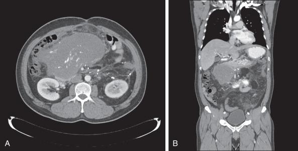 Figure 90.5, (A) A 48-year-old man with retroperitoneal and intraabdominal well-differentiated and dedifferentiated liposarcoma. Axial contrast-enhanced computed tomography (CT) images show a large heterogeneous mass with foci of calcification, consistent with osteosarcoma divergent differentiation sometimes seen with this form of sarcoma. In this situation, the finding of osteoblasts does not merit the use of chemotherapy for osteosarcoma; the risk of this tumor recurrence rests entirely with the dedifferentiated liposarcoma portion of the diagnosis. (B) The same patient as in (A), with coronal sectioning from data existing from the axial CT scans. This technique is now commonly used with both magnetic resonance imaging and CT.