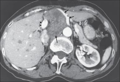 Figure 90.6, Contrast-enhanced computed tomography scan of the abdomen demonstrating a retroperitoneal undifferentiated pleomorphic sarcoma. Note the large mass (bottom arrow) between the aorta and inferior vena cava with abutment and displacement of celiac axis and hepatic artery (top arrows). The portal vein (arrowheads) is well visualized, and low-attenuation foci in the liver, which are unopacified hepatic veins, are incidentally visualized.