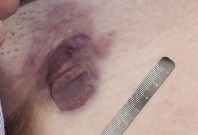 Figure 15.1, Dermatofibrosarcoma protuberans (DFSP) involving the groin of a young adult.