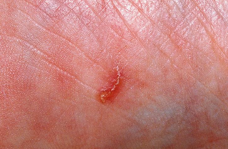 Fig. 179.1, Scabies burrow on the side of the foot.