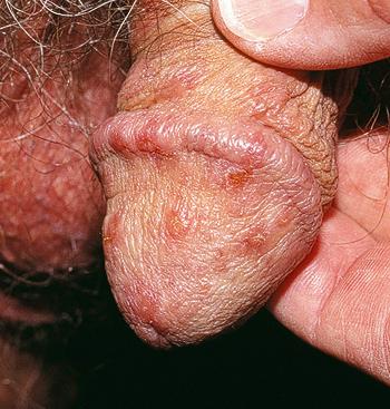 Fig. 179.4, Scabies of the penis causes intense itching and red papules on the glans, which is nearly diagnostic of the disease.