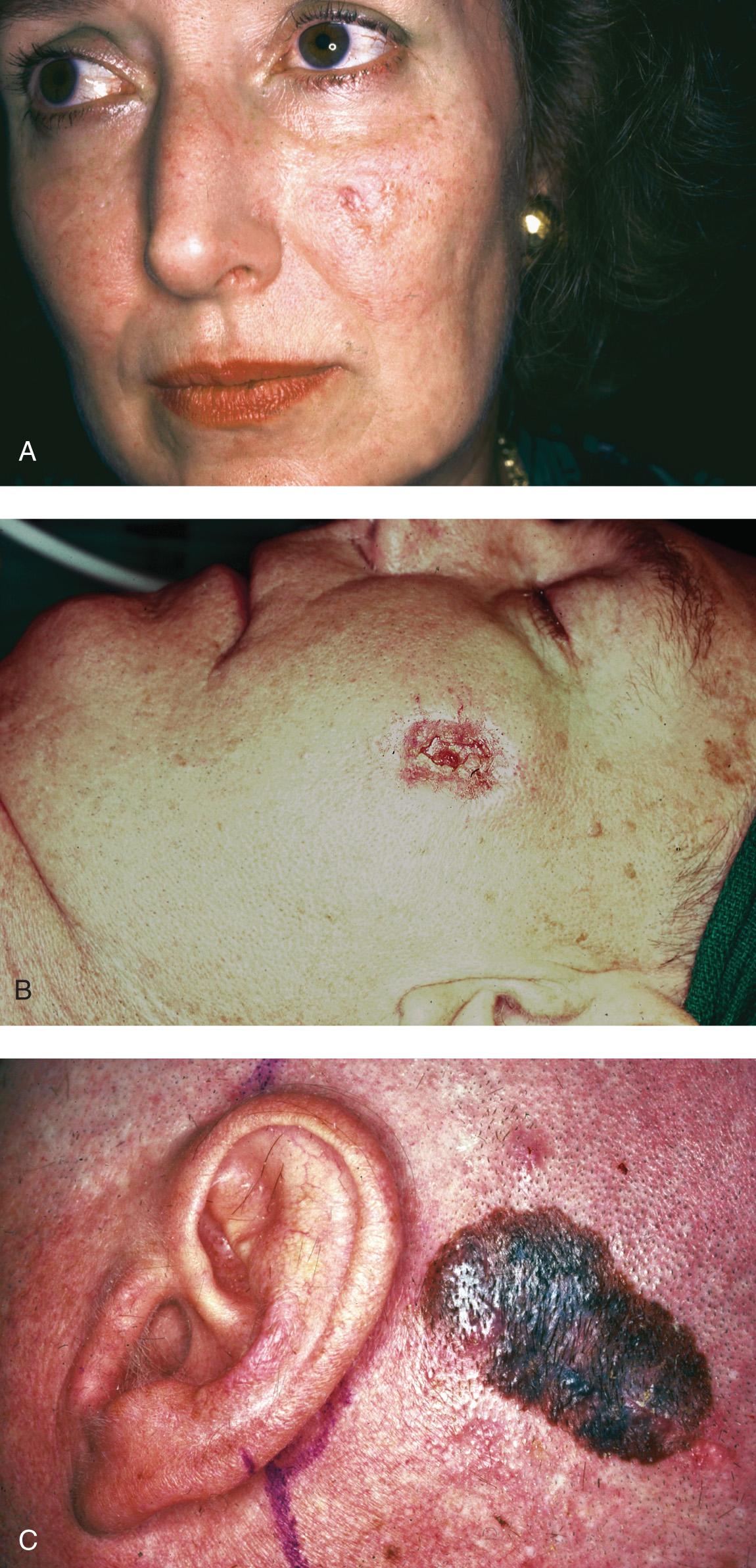 Figure 3.1, Clinical appearance of ( A ) basal cell carcinoma, ( B ) squamous cell carcinoma, and ( C ) malignant melanoma.