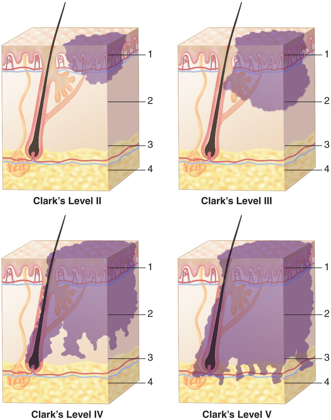 Figure 3.11, Clark's levels and Breslow thickness for histologic staging of cutaneous melanoma.
