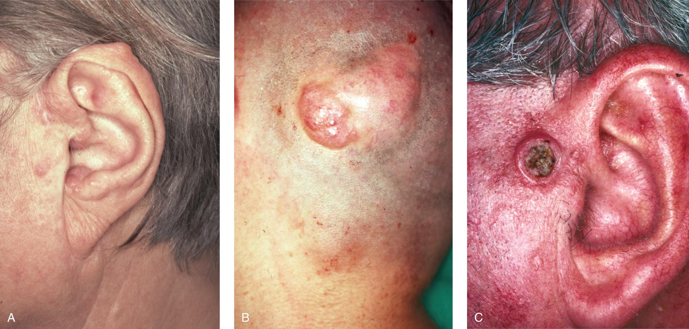 Figure 3.12, Clinical appearance of adnexal tumors. A , Benign cylindroma. B , Sweat gland carcinoma on the occipital scalp. C , Ulcerated adenocarcinoma.