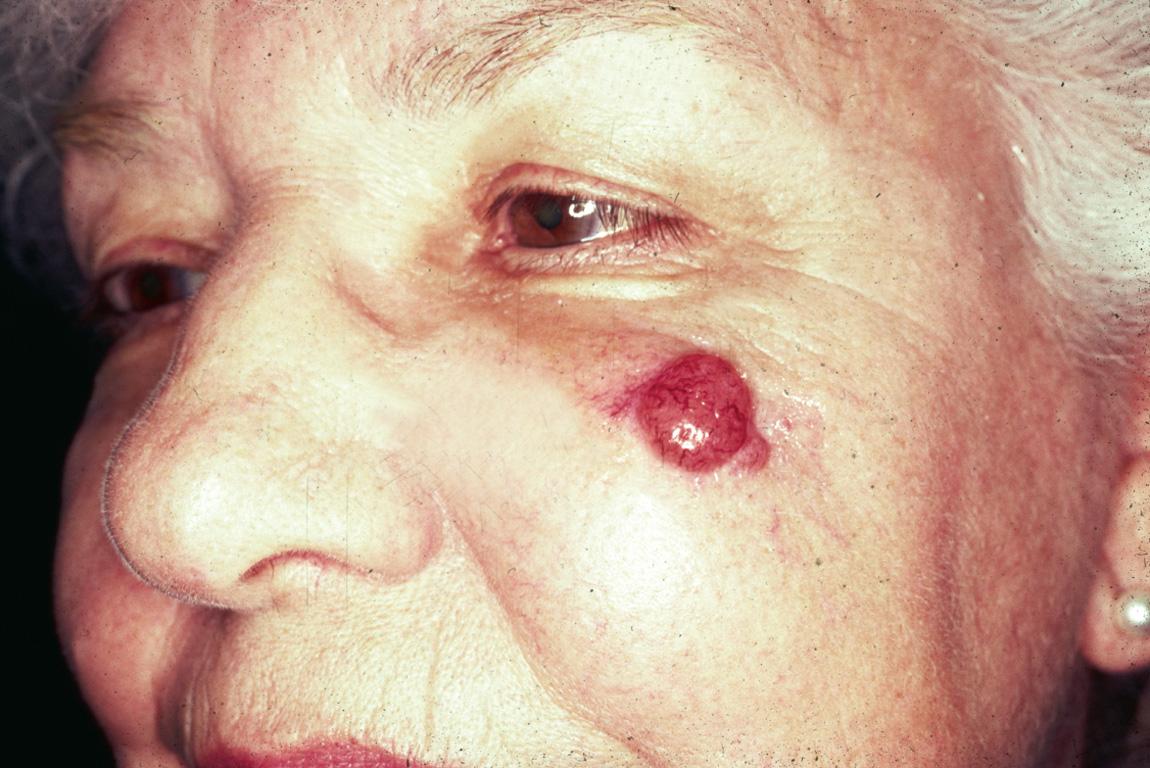 Figure 3.13, Clinical appearance of Merkel cell carcinoma.
