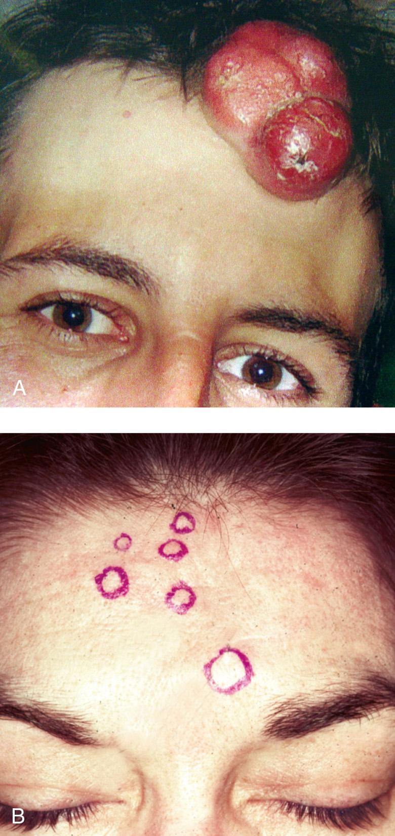 Figure 3.14, Dermatofibrosarcoma protuberans. A , Unifocal. B , Presenting with multiple nodules on the forehead.