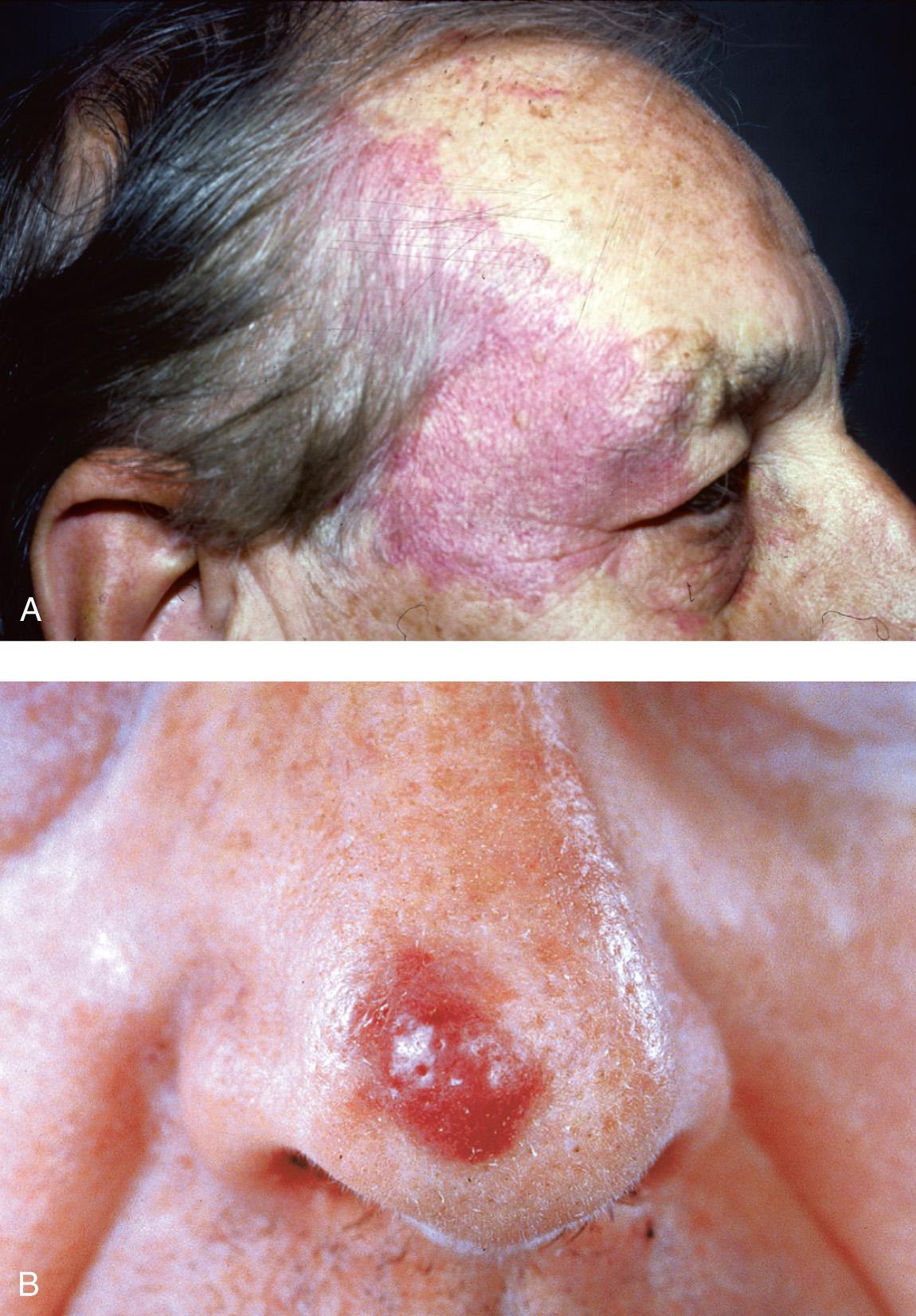 Figure 3.15, Cutaneous angiosarcoma. A , Macular. B , Nodular variant.