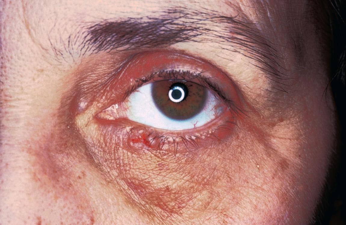 Figure 3.16, Basal cell carcinoma of the lower eyelid near the medial canthus.