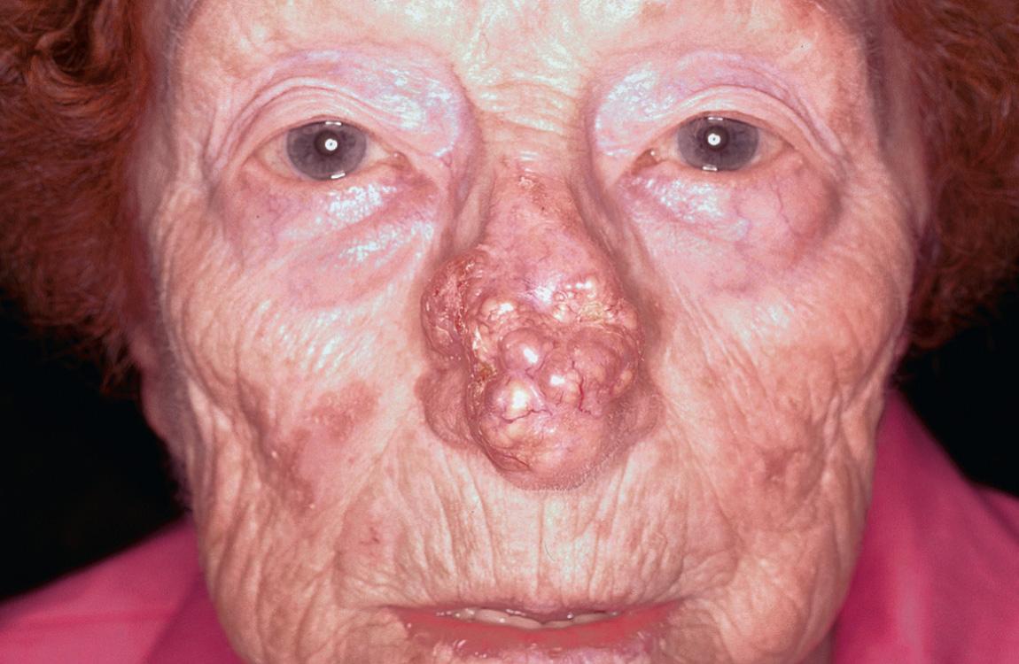 Figure 3.18, Extensive basal cell carcinoma of the dorsum of the nose.