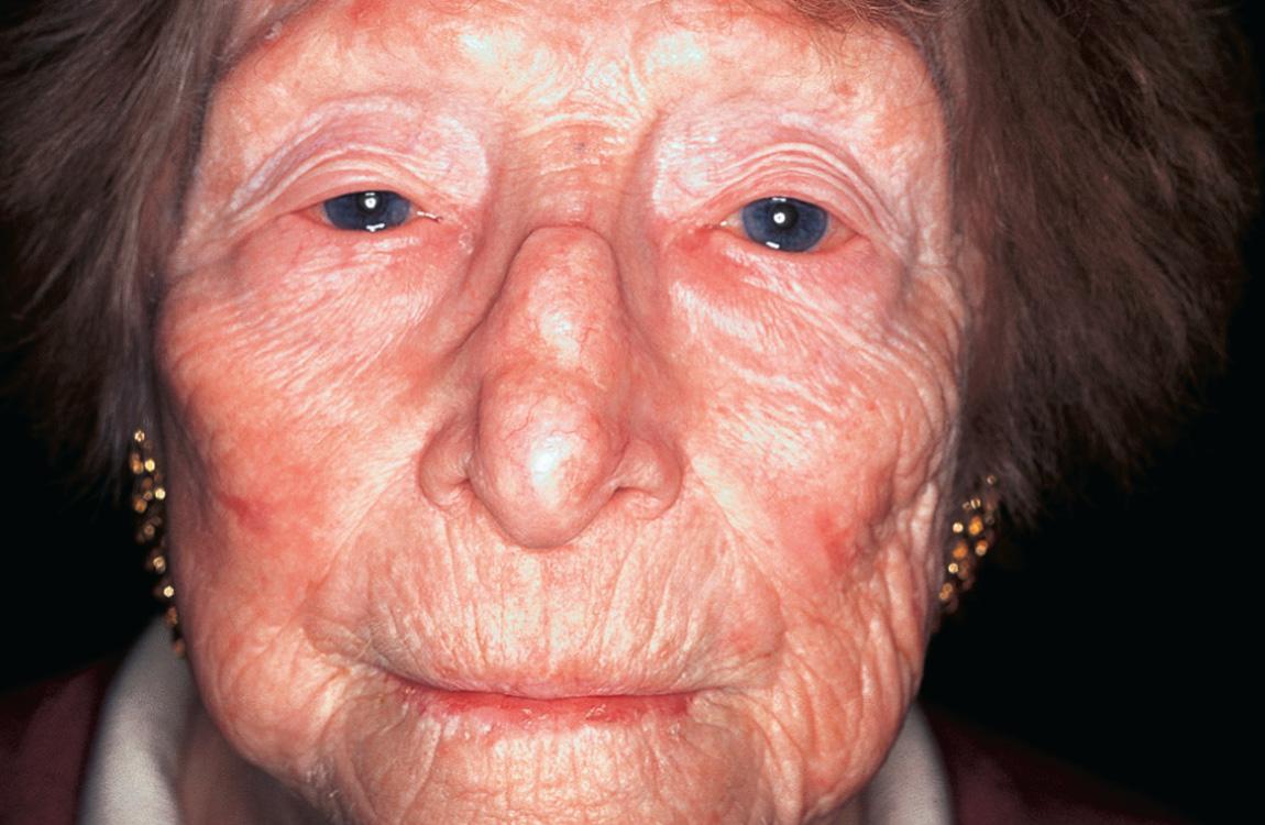 Figure 3.19, Clinical appearance 6 months after radiation therapy.