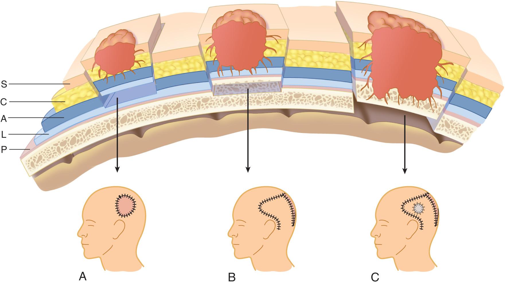 Figure 3.24, Extent of resection and reconstruction of tumors of the scalp. A , Tumor depth to the galea: Excision up to the pericranium and repair with a split-thickness skin graft. B , Tumor depth to the periosteum: Excision through the outer table and repair with a rotation scalp flap or free flap. C , Tumor invading the calvarium: Excision with a craniectomy with or without dural excision and repair with cranioplasty and a rotation flap or free flap, along with a dural graft if the dura is resected.