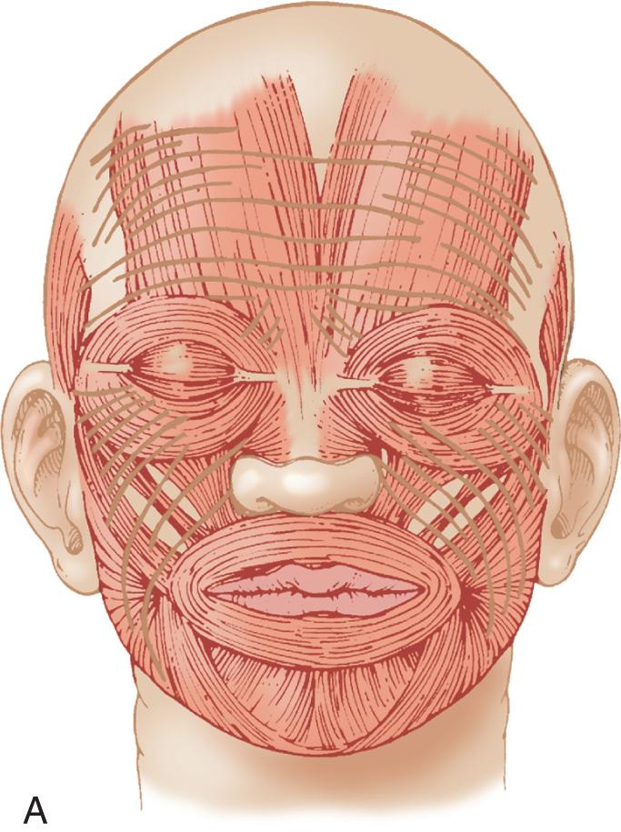 Figure 3.25, Design of facial skin incisions. A , The facial skin lines are at right angles to the underlying muscles of facial expression. B , Elliptical incisions along the facial skin lines produce optimal cosmetic results.