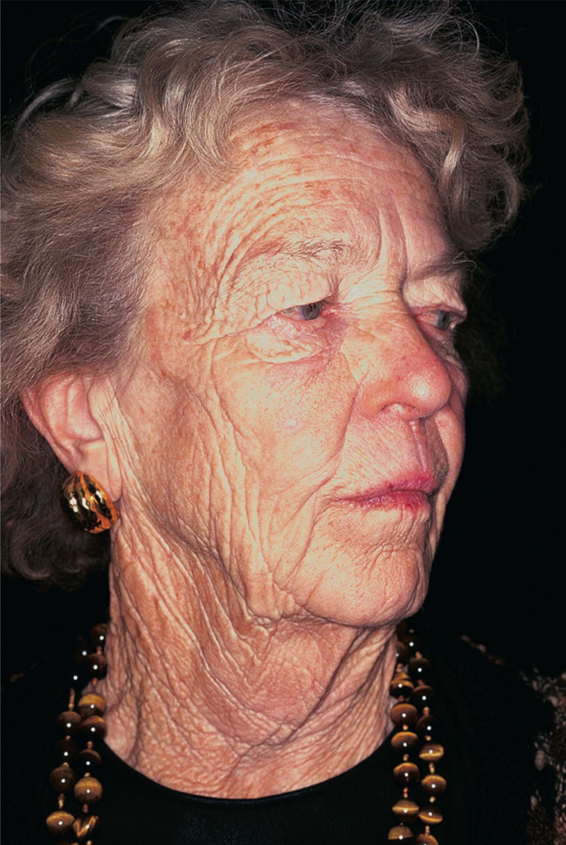 Figure 3.26, Skin lines of the face and neck.