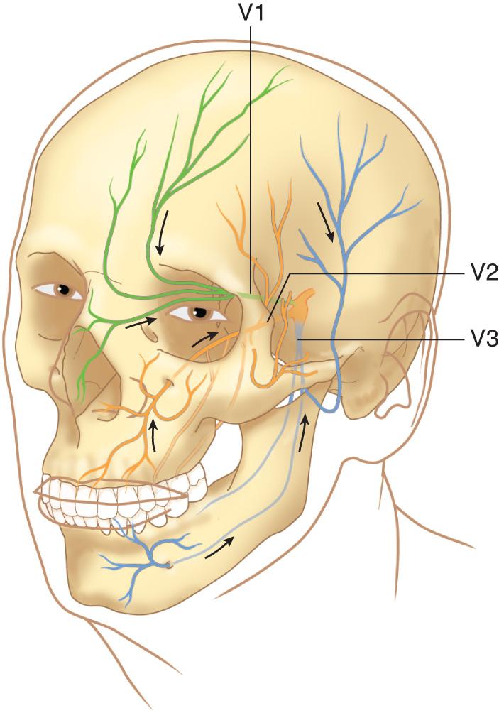 Figure 3.4, Pathways of perineural spread of cutaneous malignancies along the trigeminal nerve.