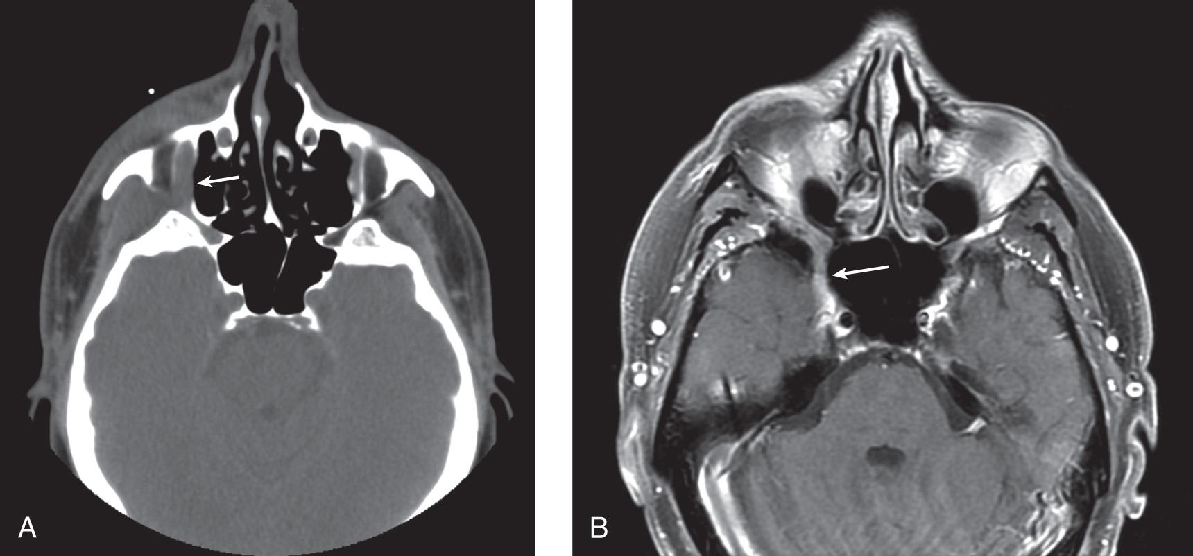 Figure 3.5, Perineural extension of a skin cancer along the second division of the trigeminal nerve. A , Computed tomography scan showing involvement of the infraorbital nerve ( arrow ). B , Magnetic resonance imaging scan showing extension into Meckel's cave ( arrow ).