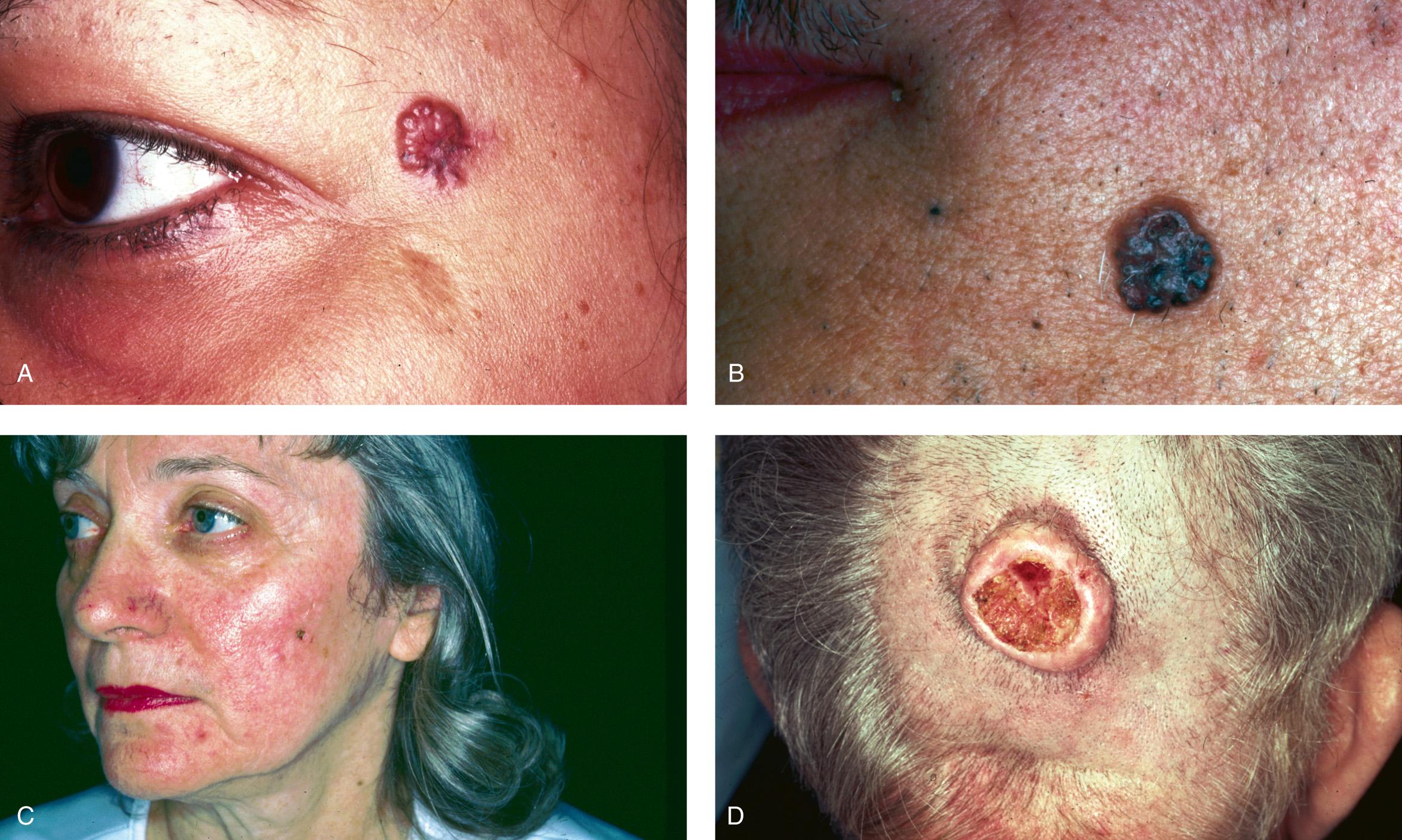 Figure 3.6, Clinical variants of basal cell carcinoma. A , Classic. B , Pigmented. C , Morpheaform.