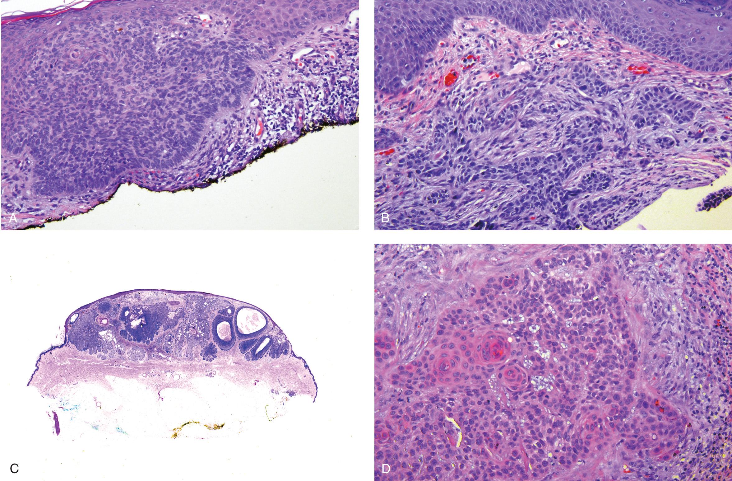 Figure 3.7, Histologic subtypes of basal cell carcinoma showing low to high risk types. A , Superficial. B , Nodular. C , Infiltrative. D , Metatypical.