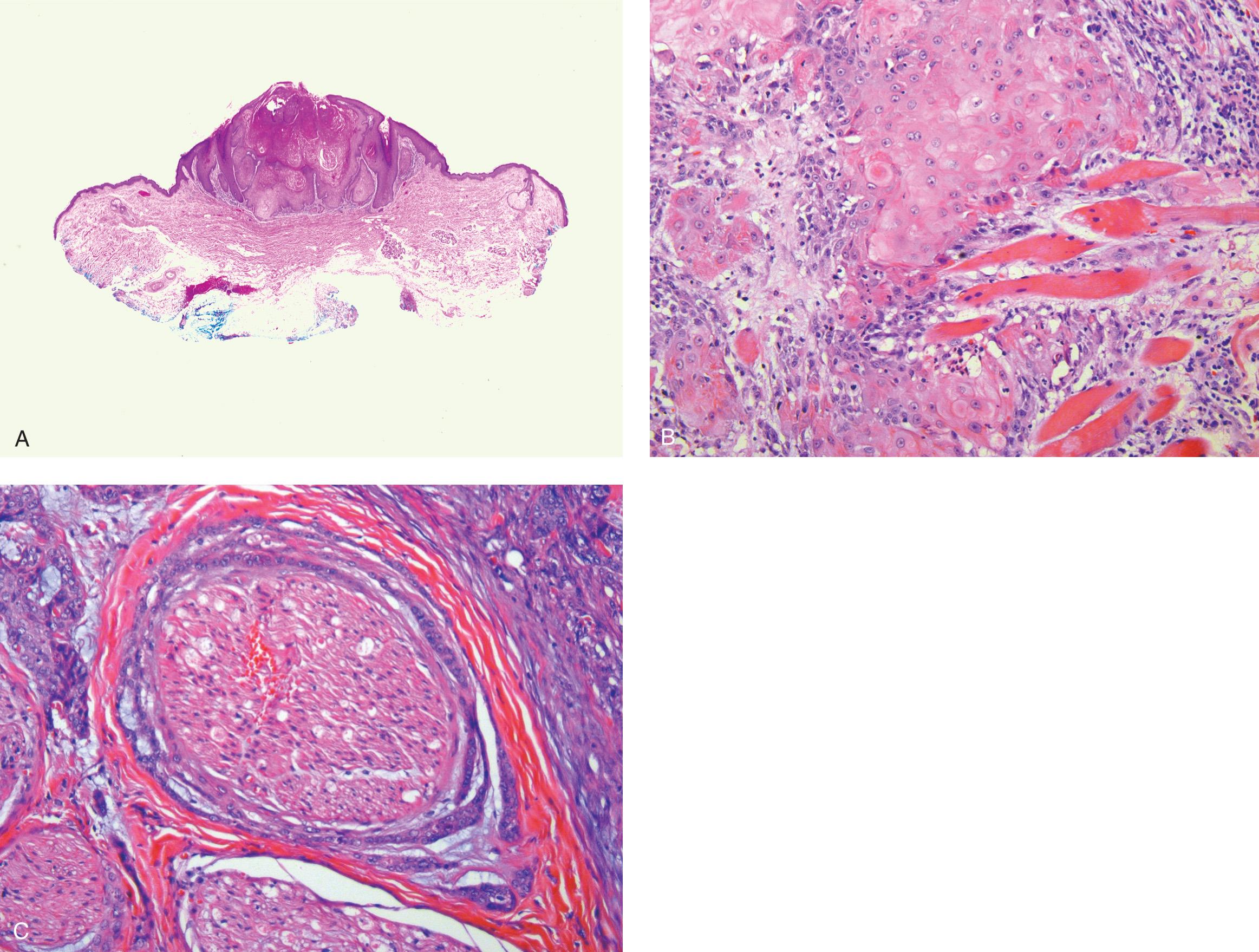 Figure 3.9, Histologic appearance of ( A ) keratoacanthoma, ( B ) invasive squamous cell carcinoma, and ( C ) squamous cell carcinoma showing neurotropism.