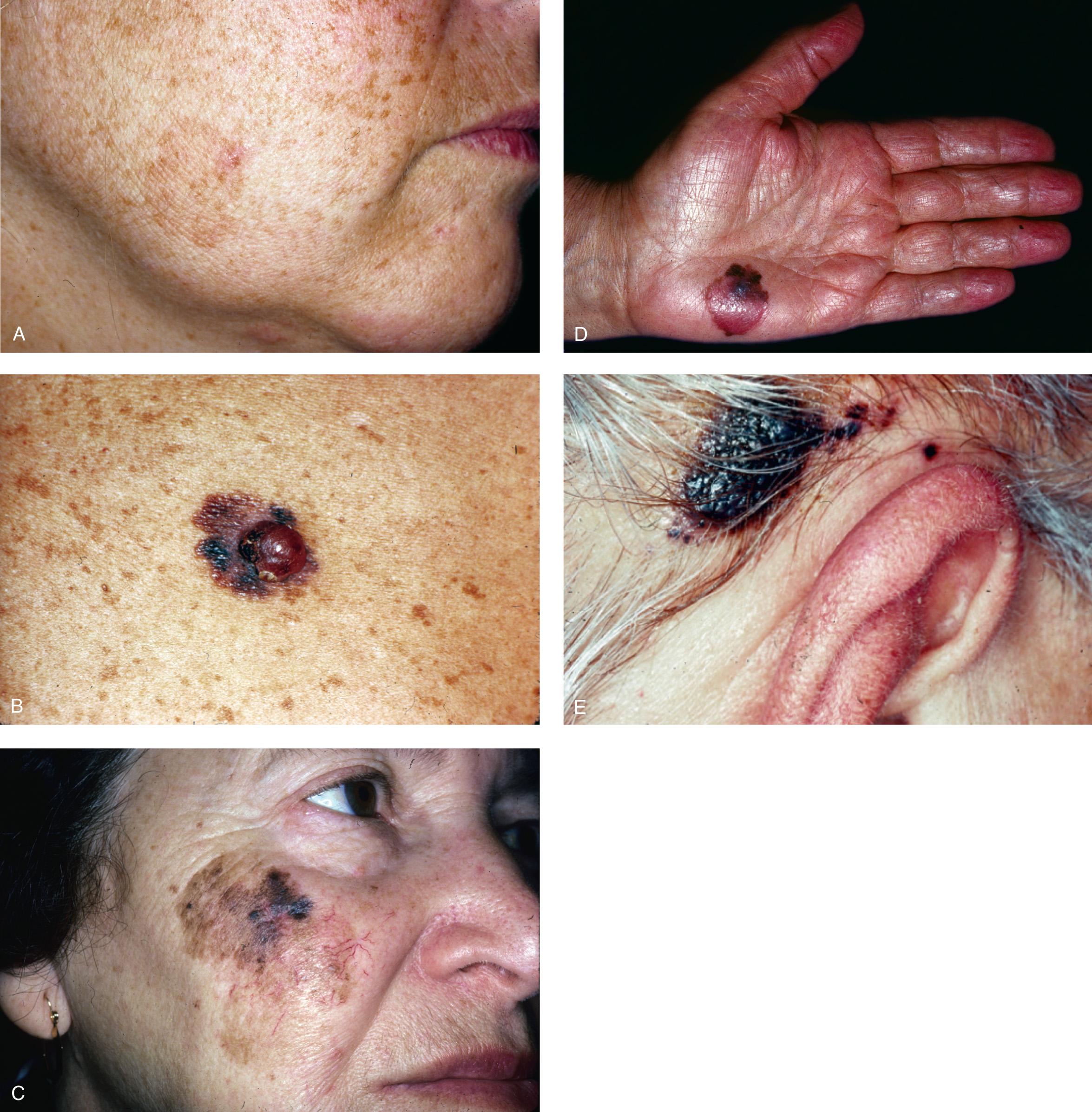 Figure 3.10, Clinical variants of cutaneous melanoma. A , In-situ. B , Superficial spreading. C , Lentigo maligna melanoma. D , Acral lentiginous melanoma. E , Nodular melanoma with satellitosis.