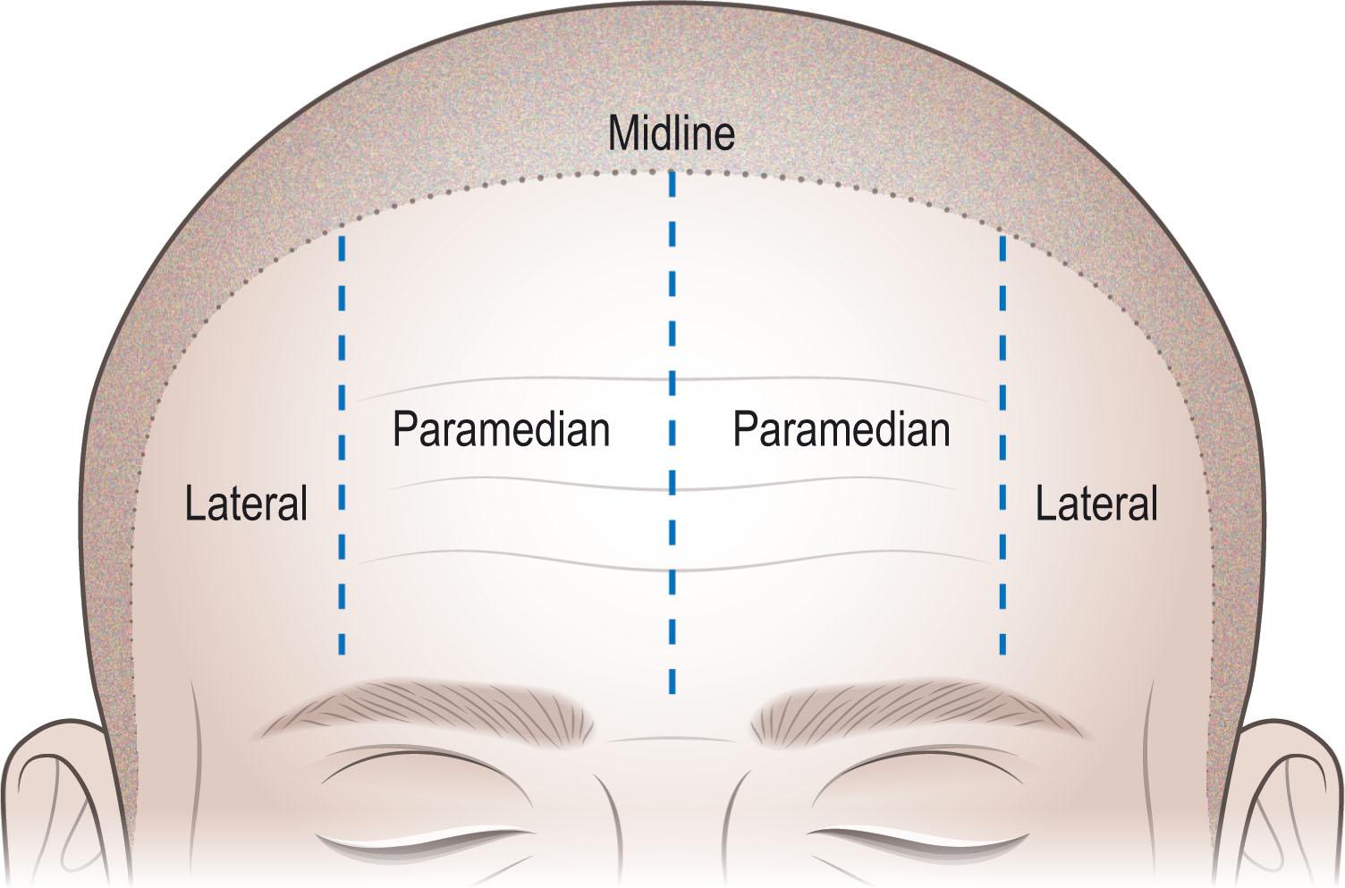 Figure 2.3, Aesthetic subunits of the forehead.