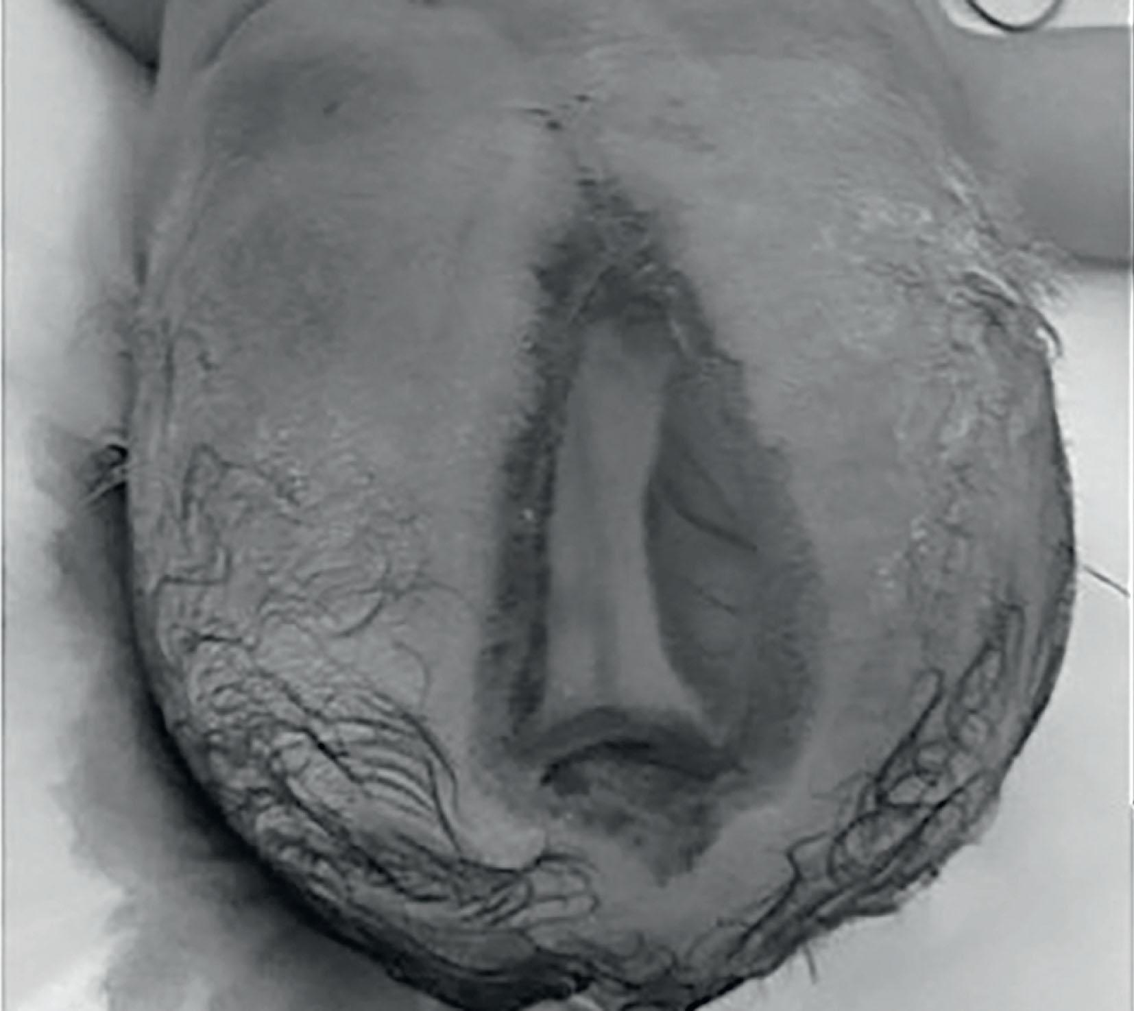 Figure 2.4, Aplasia cutis congenita of the scalp with absence of the calvarium and dura; the sagittal sinus is visible along the base of the defect.