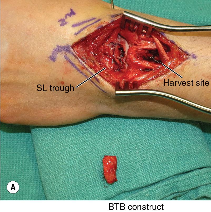 FIGURE 22.11, (A–B) BTB , Bone-tissue-bone; SL , scapholunate.