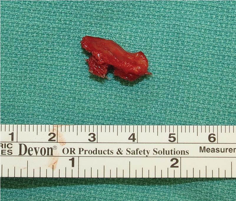 FIGURE 22.12, BTB graft. BTB , Bone-tissue-bone.