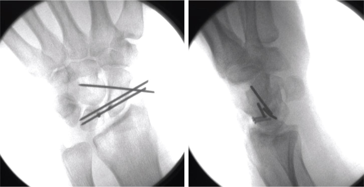 FIGURE 22.14, Final x-ray with Kirschner wires (K-wires) in place in the SL and SC to maintain reduction of the SL interval. SC , Scaphocapitate; SL , scapholunate.