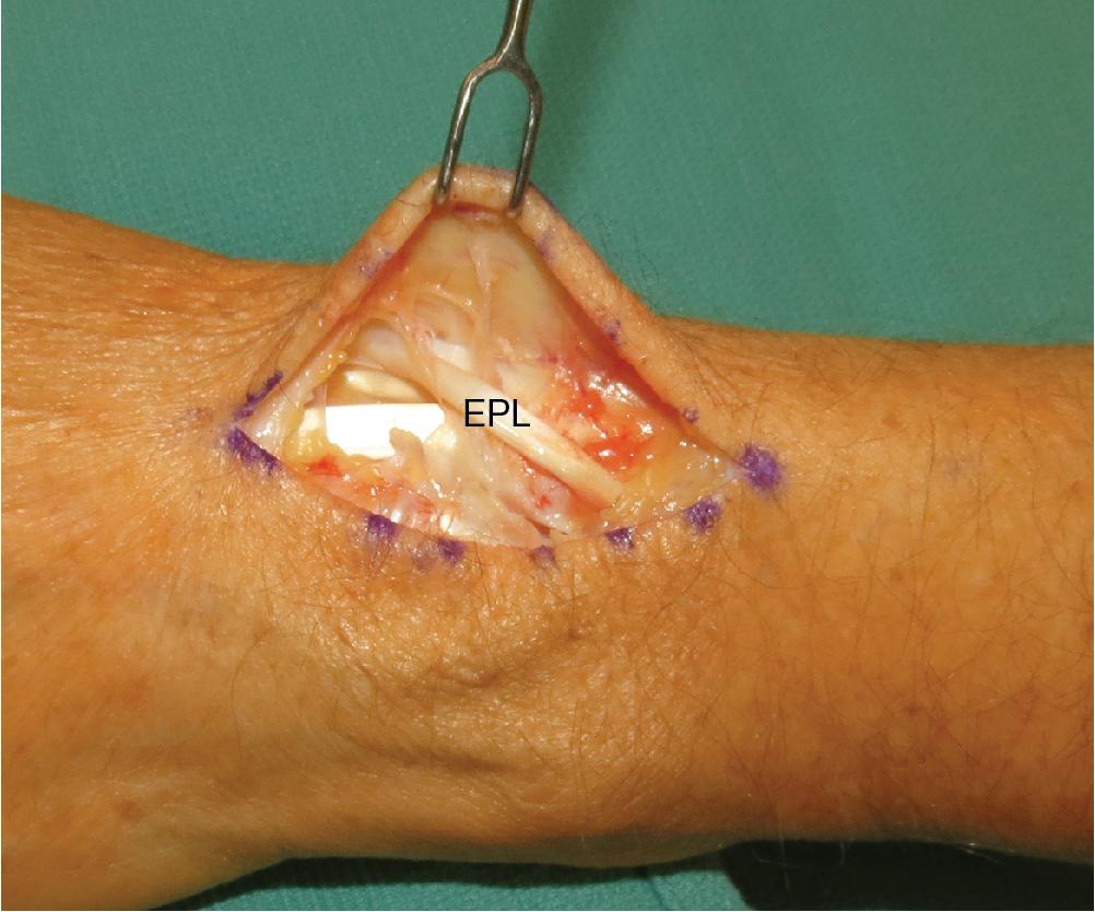 FIGURE 22.2, EPL identified. EPL, Extensor pollicis longus.