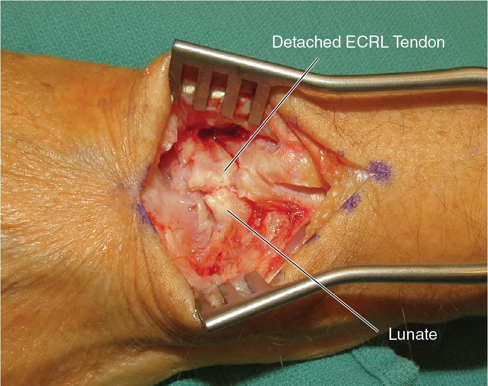 FIGURE 22.3, SL interval debrided. SL , Scapholunate.