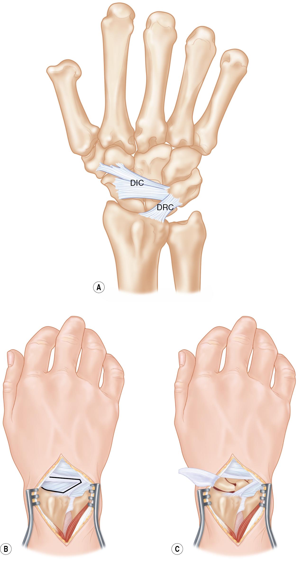 FIGURE 22.4, (A–C) DIC , Dorsal intercarpal ligament; DRC , dorsal radiocarpal ligament.