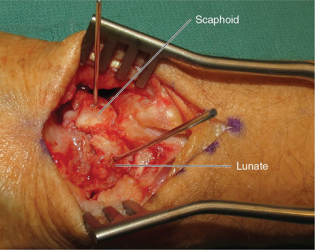 FIGURE 22.5, Kirschner wires (K-wires) in the scaphoid and lunate to aid reduction.