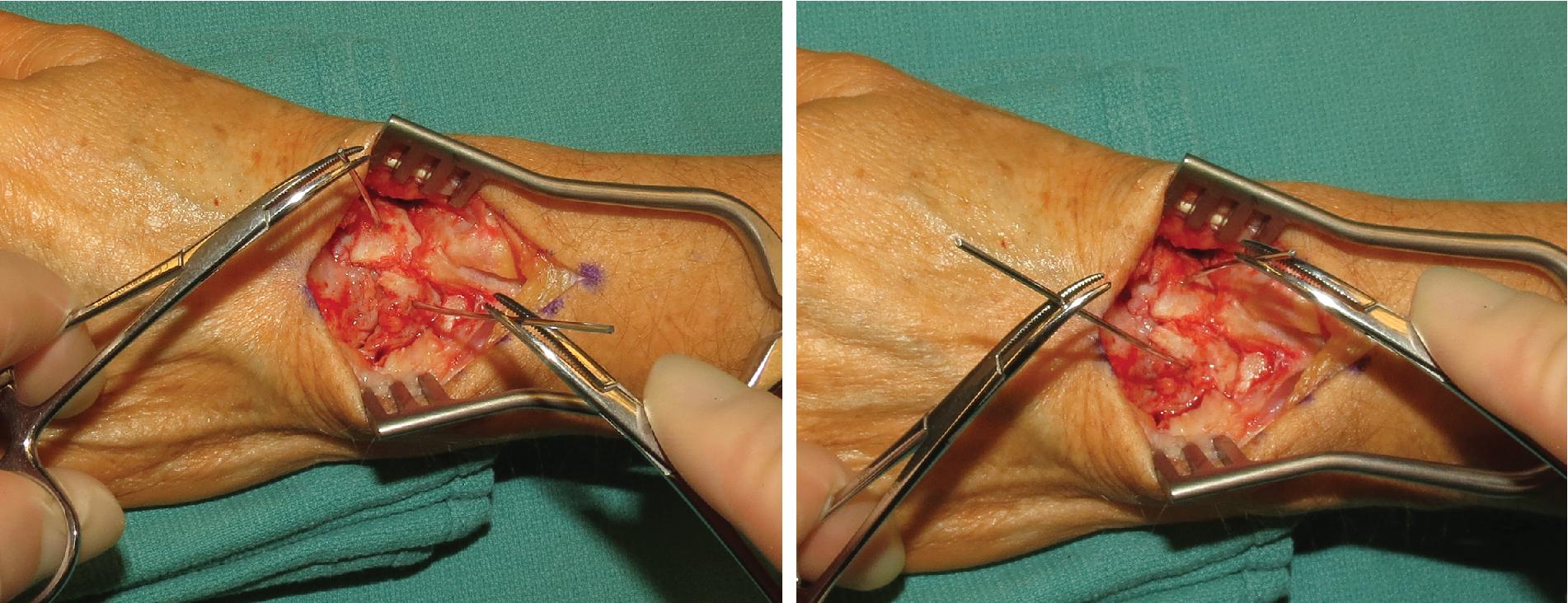 FIGURE 22.6, Correction of the DISI deformity by extending the scaphoid and flexing the lunate. DISI , Dorsal intercalated segment instability.