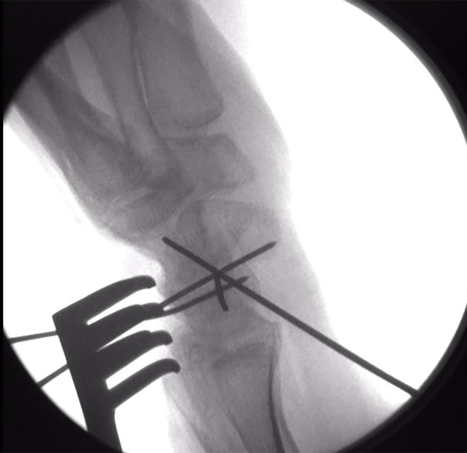 FIGURE 22.7, Reduction of DISI deformity pinned in place with Kirschner wires (K-wires) and confirmed on x-ray. DISI , Dorsal intercalated segment instability.