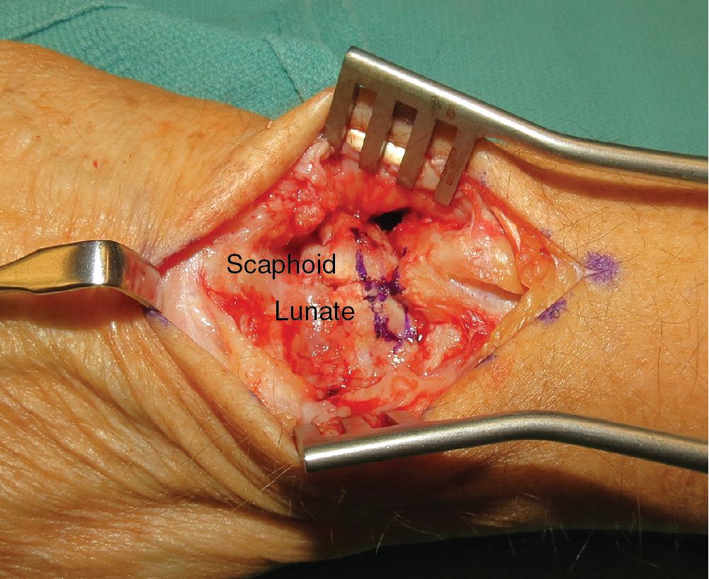 FIGURE 22.8, Create a trough in the scaphoid and lunate dorsal surface.