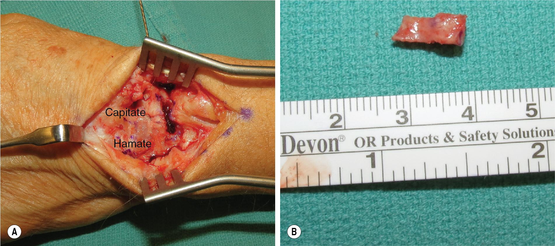 FIGURE 22.9, (A) Transposing the template. (B) Removed trough of scaphoid and lunate.