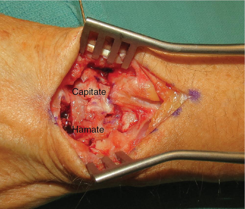 FIGURE 22.10, BTB harvested from capitate and hamate. BTB , Bone-tissue-bone.