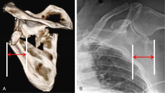 Fig. 49.13, Measurement of lateral border offset is performed on (A) a three-dimensional computed tomography (3-D CT) oriented in the semicoronal scapula plane (mimicking the anterior-posterior [AP] view) and (B) Grashey radiographs. The common displacement pattern is for the inferior scapula fragment to lateralize in relation to the superior fragment. The lateral border offset is measured drawing a line from the lateralmost extent of the inferior fragment and another perpendicular line from the lateralmost aspect of the superior fragment.