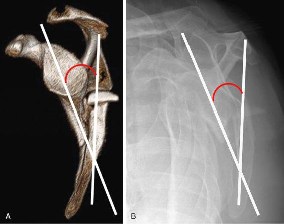 Fig. 49.14, Angulation deformity is measured on (A) a three-dimensional computed tomography (3-D CT) image of a scapula in the transscapular Y orientation and (B) a scapular Y radiograph. The angle is formed by the intersection of a line running parallel to the proximal fragment and a line running parallel to the distal fragment. Note that even though the inferior teardrop forms a concave surface over the rib cage, it is the more proximal straight portion of the intramedullary canal that is used for the measurement.