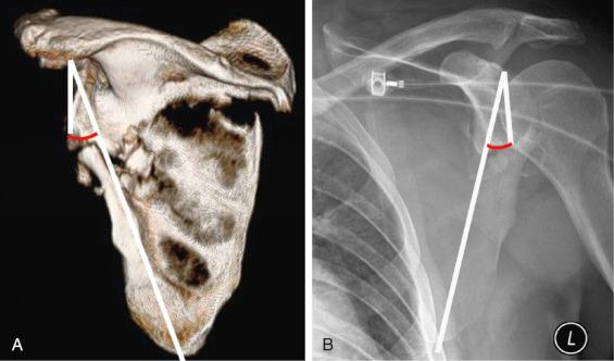 Fig. 49.15, Measurement of glenopolar angle is performed on (A) a three-dimensional computed tomography (3-D CT) oriented in the coronal scapula plane (mimicking the anterior-posterior [AP] view) and (B) Grashey radiographs. The glenopolar angle measurement is made by drawing a line from the inferior to the superior pole of the glenoid fossa and another line from the superior pole to the apex of the scapula body's inferior angle.