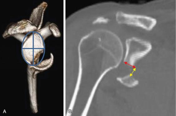 Fig. 49.16, Measurements for the percentage of articular involvement (A) can be performed on a three-dimensional computed tomography (3-D CT) oriented in the scapular Y view, whereas articular step (red arrow) and gap (yellow arrow) are best measured on two-dimensional (2-D) CT (B).