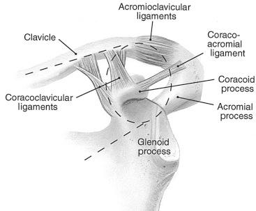 Fig. 49.17, Goss first described the concept of the superior shoulder suspensory complex (SSSC) to characterize the osseoligamentous ring that includes the glenoid, coracoid, clavicle, and acromion process along with the connecting soft tissues between these structures (i.e., coracoclavicular ligament and acromioclavicular joint capsule). Goss taught that a double disruption of the superior shoulder suspensory complex is an unstable injury.