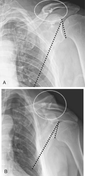 Fig. 49.18, (A) Anteroposterior view of a shoulder that reveals a scapula neck and ipsilateral clavicle fracture shortly after injury. The clavicle is not shortened, and the glenoid is not medialized significantly. For these reasons, nonoperative management was initially chosen. (B) Anteroposterior radiograph taken 1 week later shows a significant change in alignment, despite immobilization. The patient was concerned that his shoulder appeared drooped and was more painful. Note the increased shortening of the clavicle, decreased glenopolar angle of the scapula, and significant bayonetting of ribs 2 through 7 further highlighting the concept of medialization.