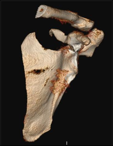 Fig. 49.19, A 3-D CT reconstructed image rotated to the anterior/posterior view of a left-sided scapula fracture, illustrating a common superior glenoid fracture variant (Ideberg type III), which often extends just inferior to the coracoid.